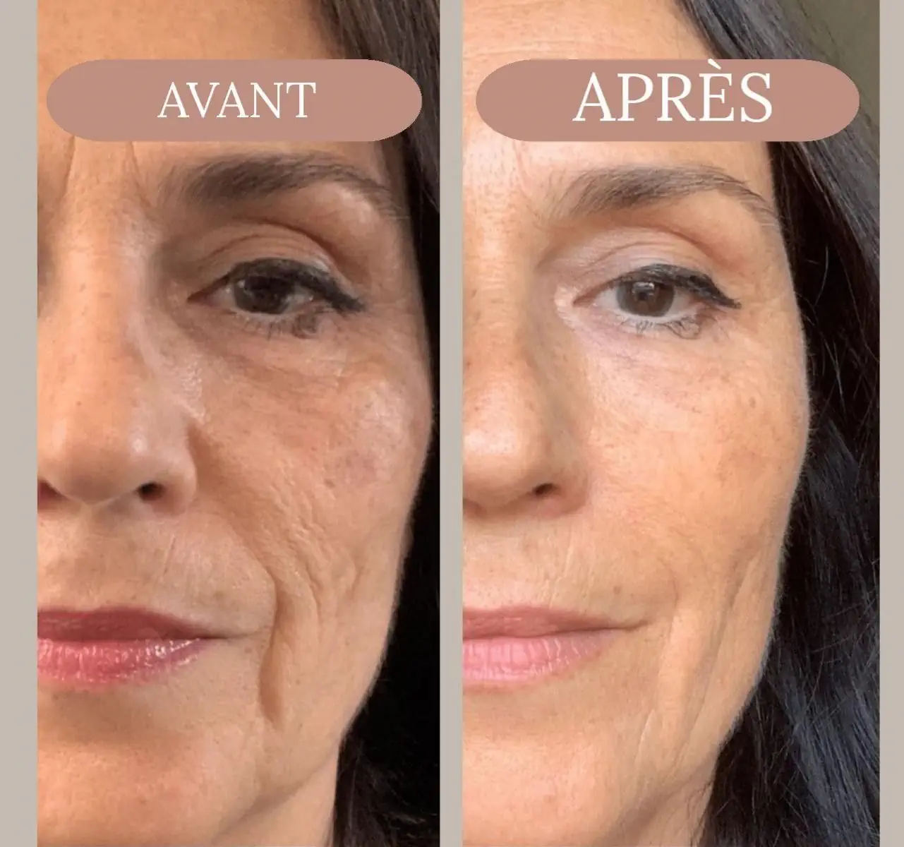 Avant après Gloria