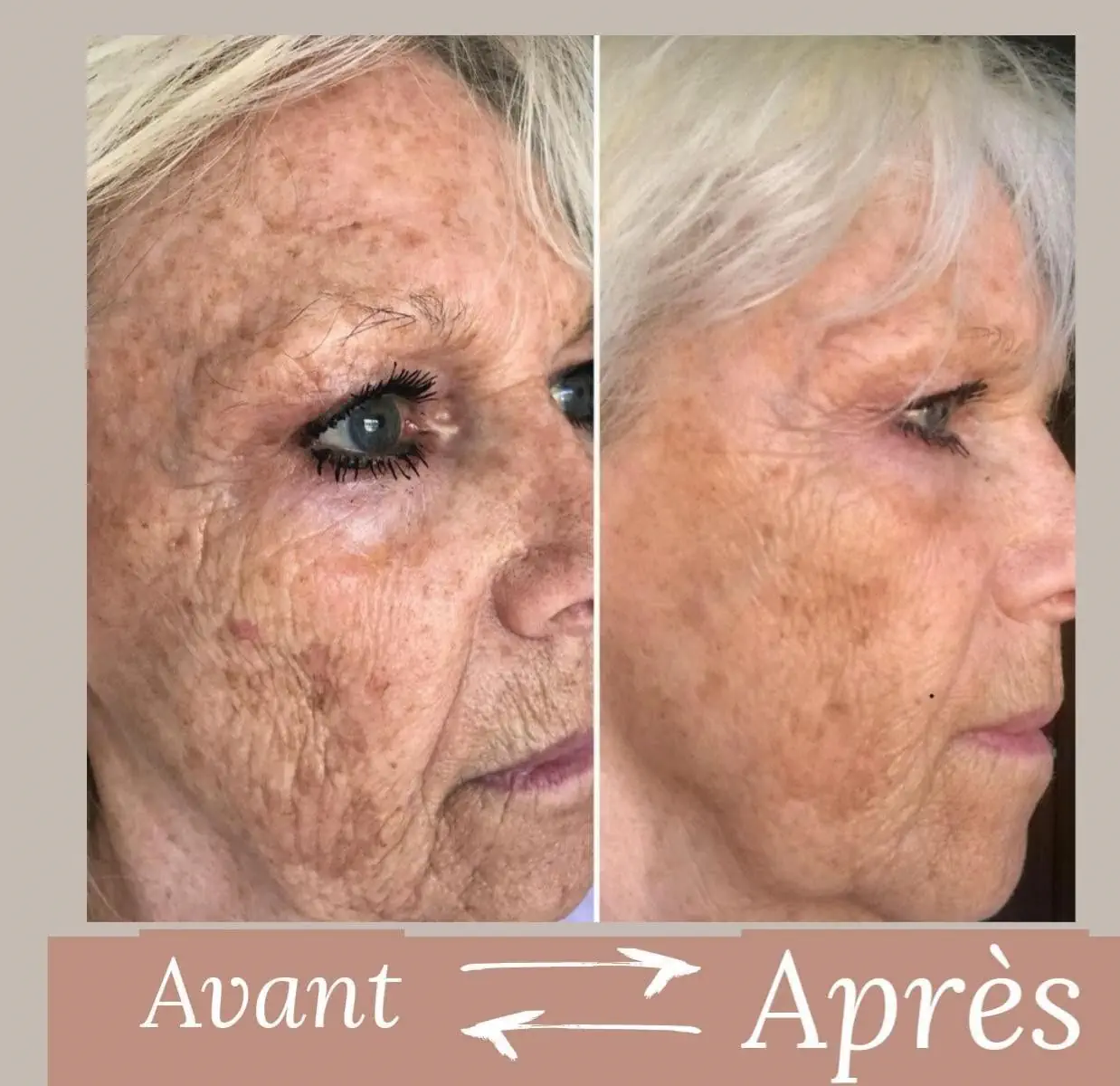 Avant après Michelle