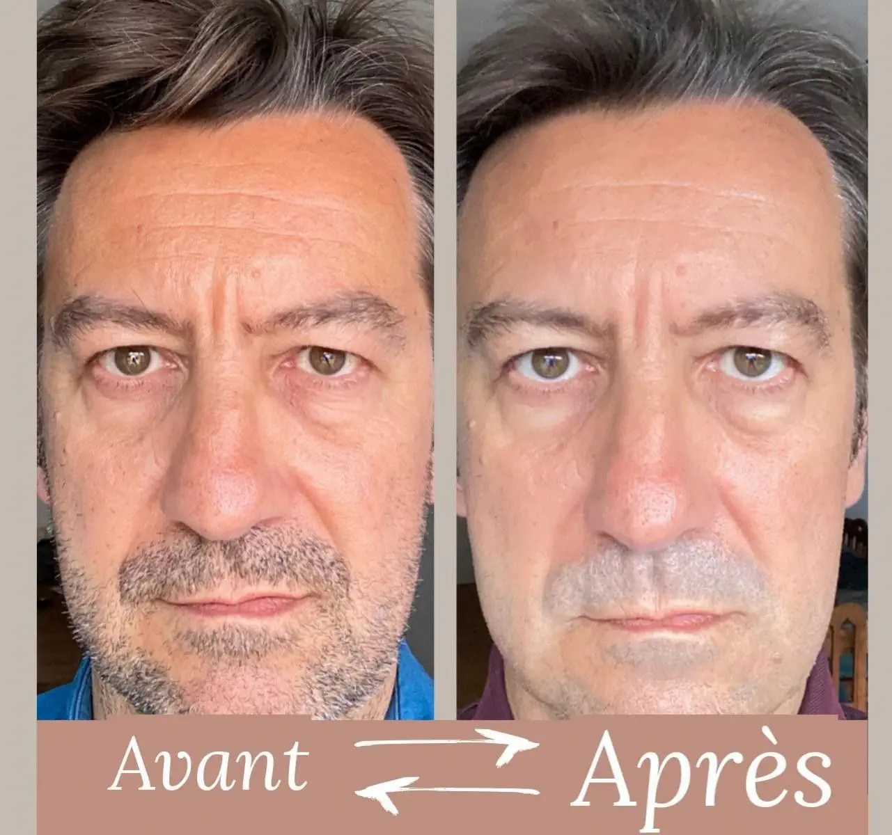Avant après Pierre
